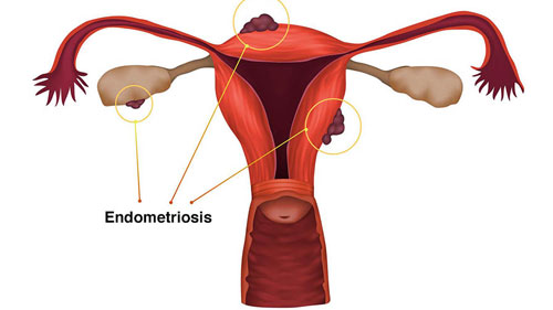 Endometriosis Treatment