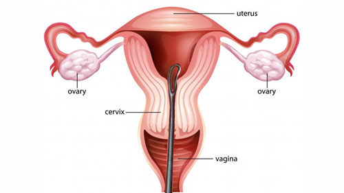 Dilation and Curettage (D&C)