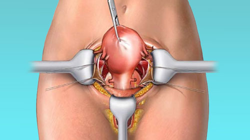 Hysterectomy