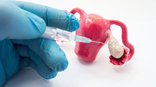 Ovulation Induction