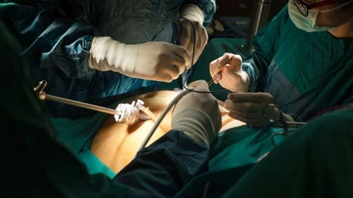 Myomectomy (Laparoscopic Myomectomy Surgery)