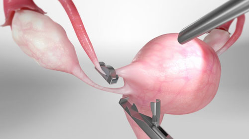 Tubal Ligation (Laparoscopic Tubal Ligation Surgery)