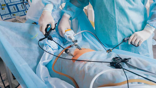 Endometriosis Surgery (Laparoscopic Endometriosis Surgery)