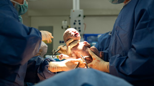 Normal Delivery & Caesarean Section